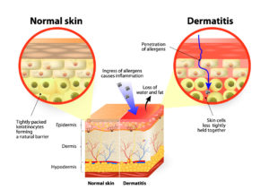 eczema-infogram-shutterstock_275935922-paid-for-rights-1182016