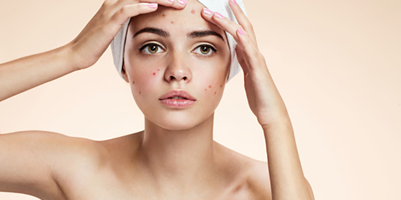 What to Do About a Pimple