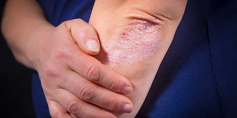 Managing Eczema: Don’t Forget the Basics