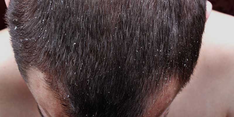 What to Do about Dandruff