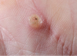 What Does a Wart Look Like?