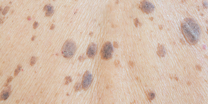 What Are These Brown, Rough Moles on My Skin? – Dr. Leslie Baumann