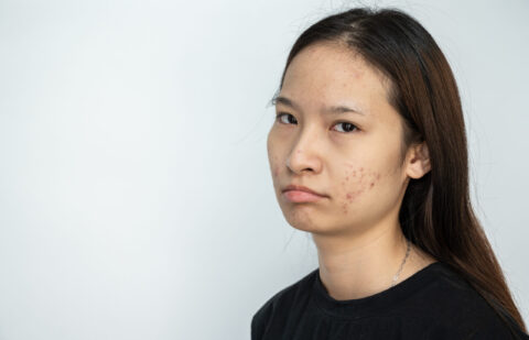asian woman with acne frowning